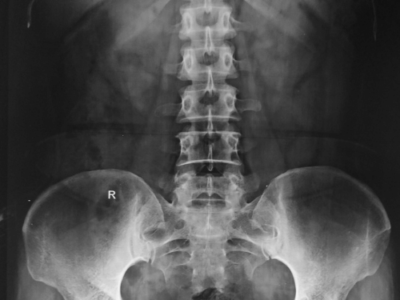 low back xray from a chiropractic office