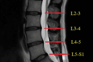An MRI image of the lumbar spine showing disc herniations resulting in sciatica.
