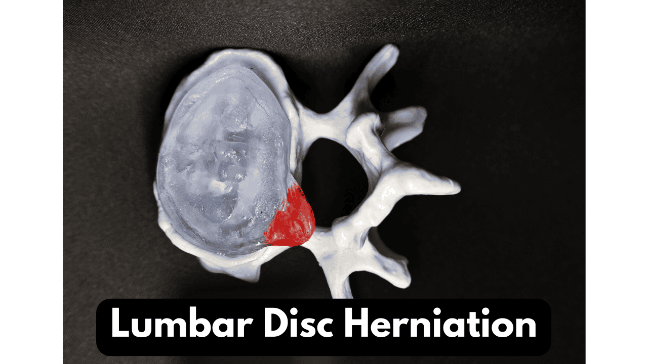a lumbar disc herniation causing sciatica shown on a model